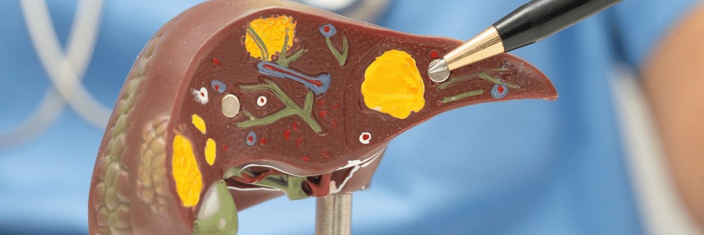 Gallstones: An Overview